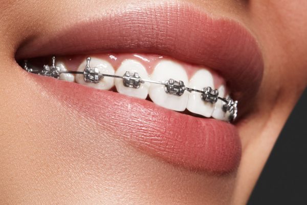 the-smile-space-orthodontie-appareil-dentaire-metallique (1)